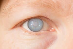 female eye with cataract